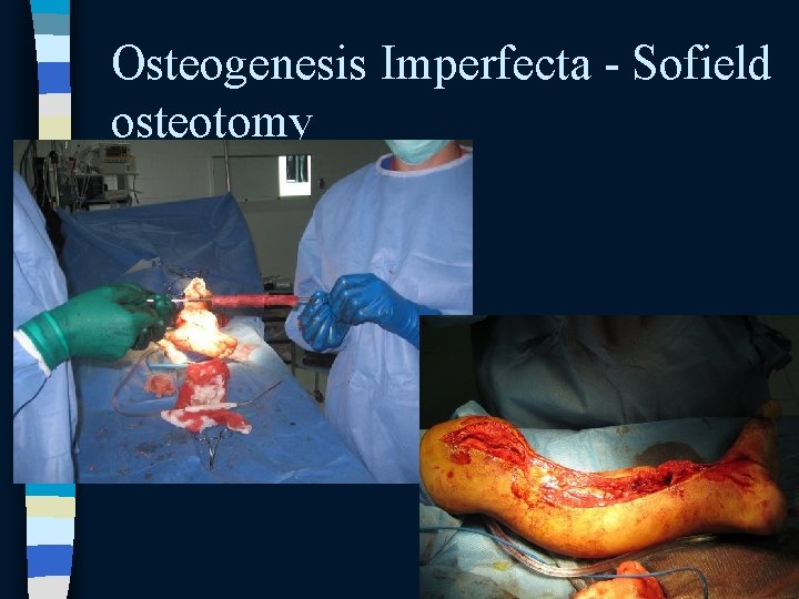 Osteogenesis Imperfecta - Sofield osteotomy Osteogenesis Imperfecta - Sofield osteotomy