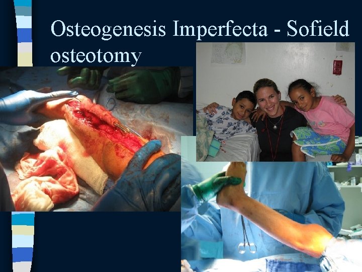 Osteogenesis Imperfecta - Sofield osteotomy Osteogenesis Imperfecta - Sofield osteotomy