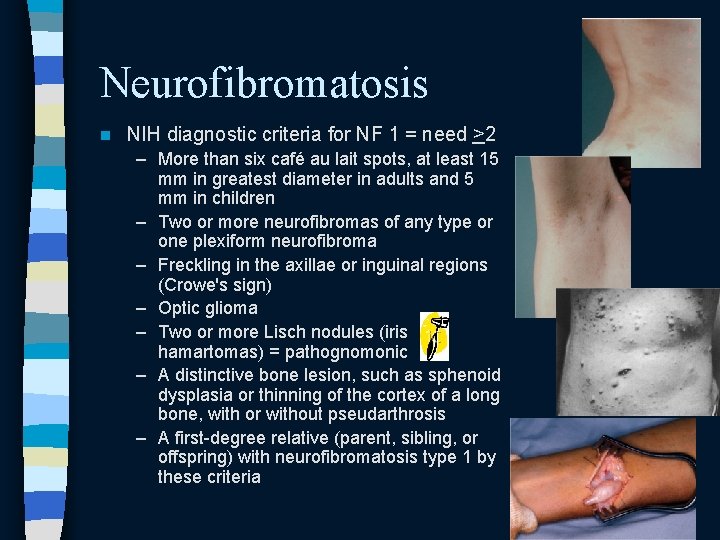 Neurofibromatosis n NIH diagnostic criteria for NF 1 = need >2 – More than Neurofibromatosis n NIH diagnostic criteria for NF 1 = need >2 – More than