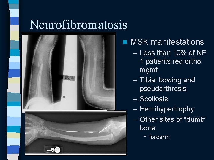 Neurofibromatosis n MSK manifestations – Less than 10% of NF 1 patients req ortho Neurofibromatosis n MSK manifestations – Less than 10% of NF 1 patients req ortho