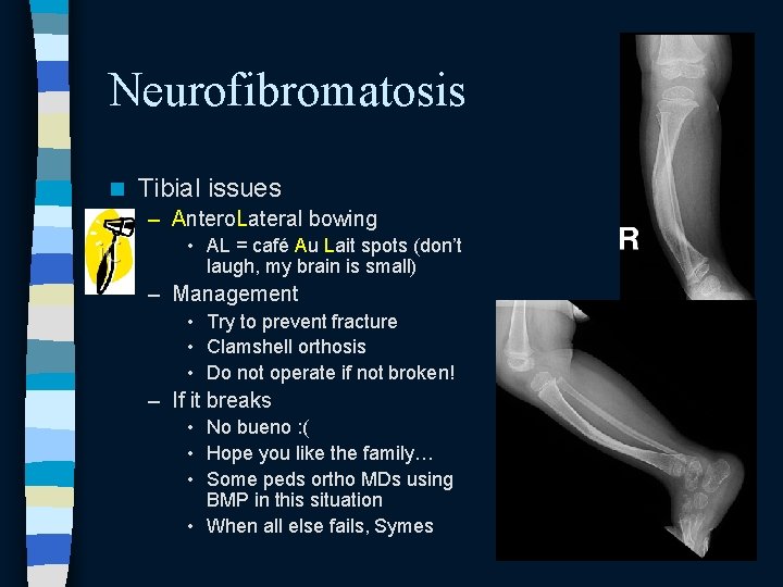 Neurofibromatosis n Tibial issues – Antero. Lateral bowing • AL = café Au Lait Neurofibromatosis n Tibial issues – Antero. Lateral bowing • AL = café Au Lait