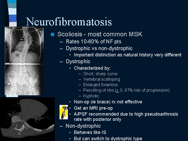 Neurofibromatosis n Scoliosis - most common MSK – Rates 10 -60% of NF pts Neurofibromatosis n Scoliosis - most common MSK – Rates 10 -60% of NF pts
