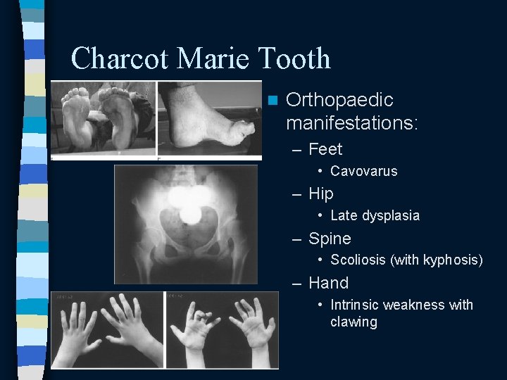 Charcot Marie Tooth n Orthopaedic manifestations: – Feet • Cavovarus – Hip • Late Charcot Marie Tooth n Orthopaedic manifestations: – Feet • Cavovarus – Hip • Late