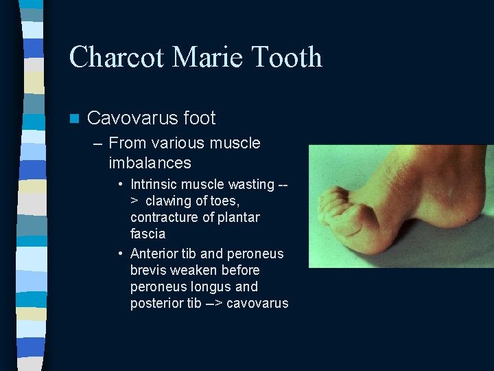 Charcot Marie Tooth n Cavovarus foot – From various muscle imbalances • Intrinsic muscle Charcot Marie Tooth n Cavovarus foot – From various muscle imbalances • Intrinsic muscle