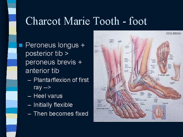 Charcot Marie Tooth - foot n Peroneus longus + posterior tib > peroneus brevis Charcot Marie Tooth - foot n Peroneus longus + posterior tib > peroneus brevis
