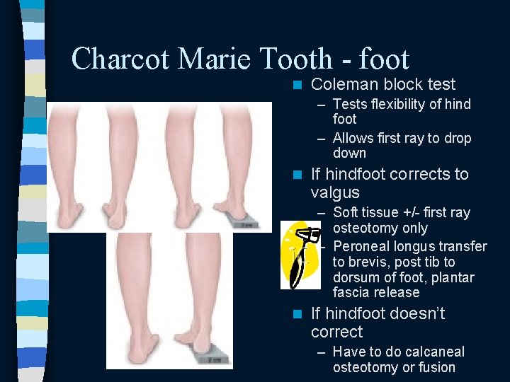 Charcot Marie Tooth - foot n Coleman block test – Tests flexibility of hind Charcot Marie Tooth - foot n Coleman block test – Tests flexibility of hind