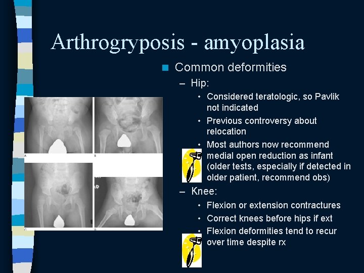 Arthrogryposis - amyoplasia n Common deformities – Hip: • Considered teratologic, so Pavlik not Arthrogryposis - amyoplasia n Common deformities – Hip: • Considered teratologic, so Pavlik not