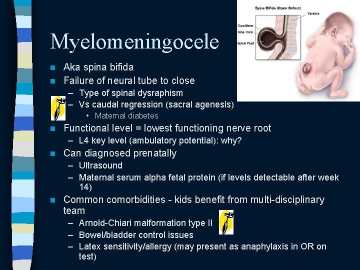 Myelomeningocele Aka spina bifida n Failure of neural tube to close n – Type Myelomeningocele Aka spina bifida n Failure of neural tube to close n – Type