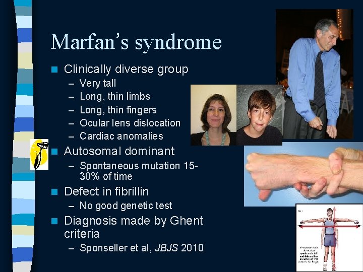Marfan’s syndrome n Clinically diverse group – – – n Very tall Long, thin Marfan’s syndrome n Clinically diverse group – – – n Very tall Long, thin