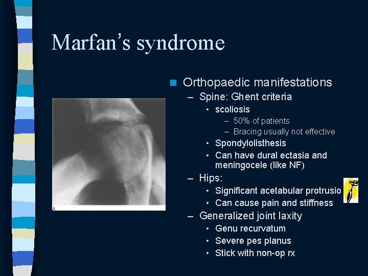 Marfan’s syndrome n Orthopaedic manifestations – Spine: Ghent criteria • scoliosis – 50% of Marfan’s syndrome n Orthopaedic manifestations – Spine: Ghent criteria • scoliosis – 50% of