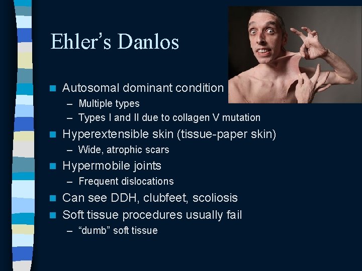 Ehler’s Danlos n Autosomal dominant condition – Multiple types – Types I and II Ehler’s Danlos n Autosomal dominant condition – Multiple types – Types I and II