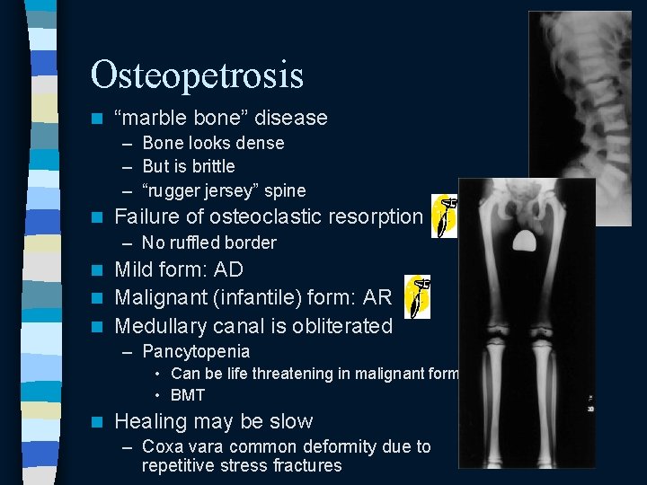 Osteopetrosis n “marble bone” disease – Bone looks dense – But is brittle – Osteopetrosis n “marble bone” disease – Bone looks dense – But is brittle –
