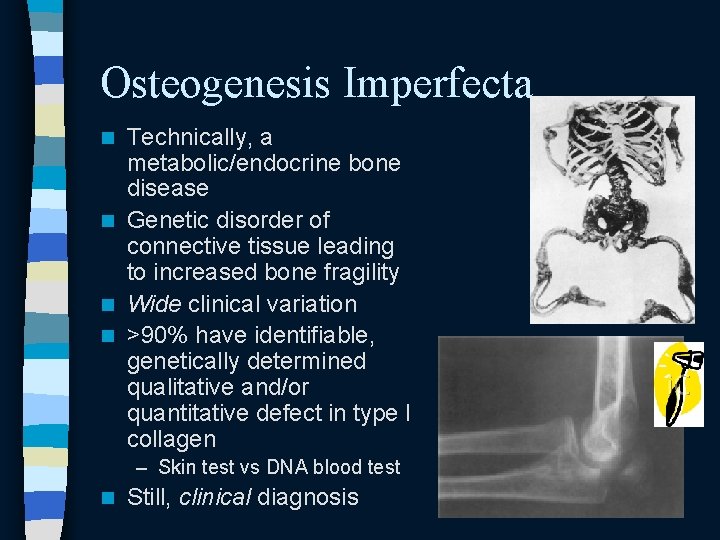Osteogenesis Imperfecta Technically, a metabolic/endocrine bone disease n Genetic disorder of connective tissue leading Osteogenesis Imperfecta Technically, a metabolic/endocrine bone disease n Genetic disorder of connective tissue leading