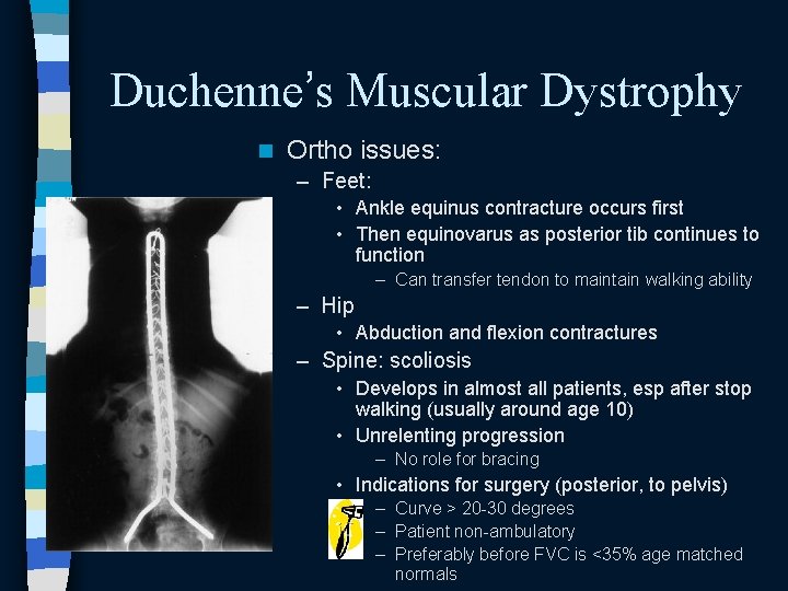 Duchenne’s Muscular Dystrophy n Ortho issues: – Feet: • Ankle equinus contracture occurs first Duchenne’s Muscular Dystrophy n Ortho issues: – Feet: • Ankle equinus contracture occurs first