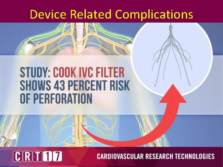 Device Related Complications 