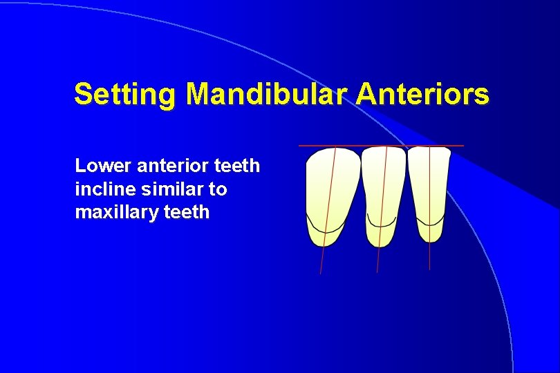 Setting Mandibular Anteriors Lower anterior teeth incline similar to maxillary teeth 