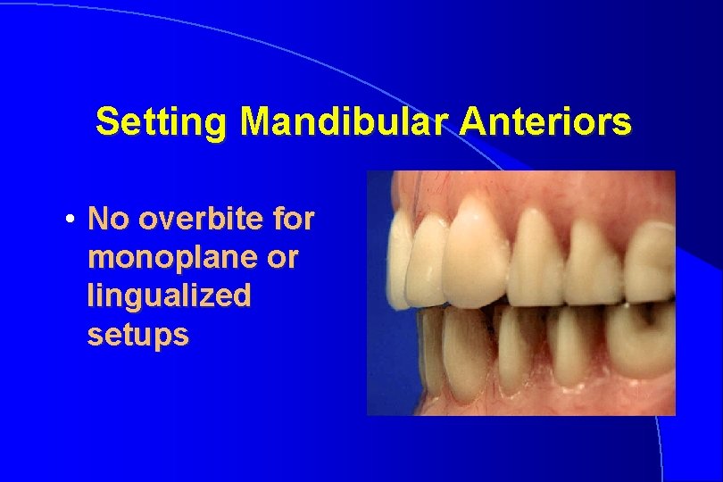 Setting Mandibular Anteriors • No overbite for monoplane or lingualized setups 