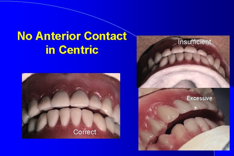 No Anterior Contact in Centric Insufficient Excessive Correct 