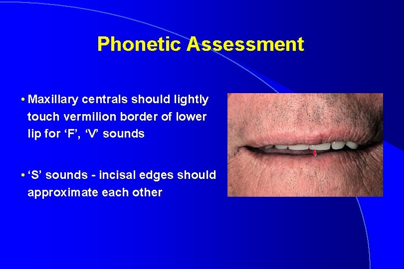 Phonetic Assessment • Maxillary centrals should lightly touch vermilion border of lower lip for