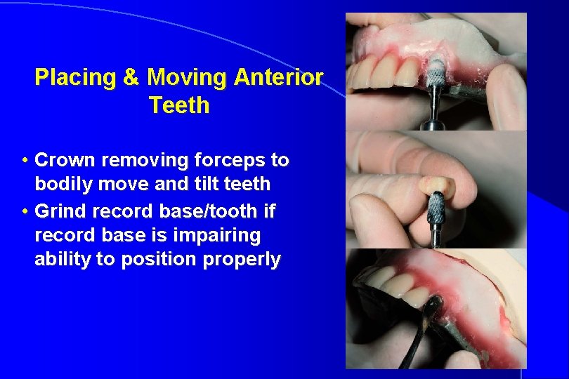 Placing & Moving Anterior Teeth • Crown removing forceps to bodily move and tilt