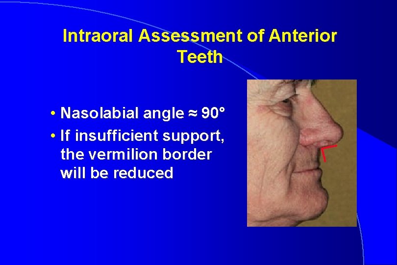 Intraoral Assessment of Anterior Teeth • Nasolabial angle ≈ 90° • If insufficient support,