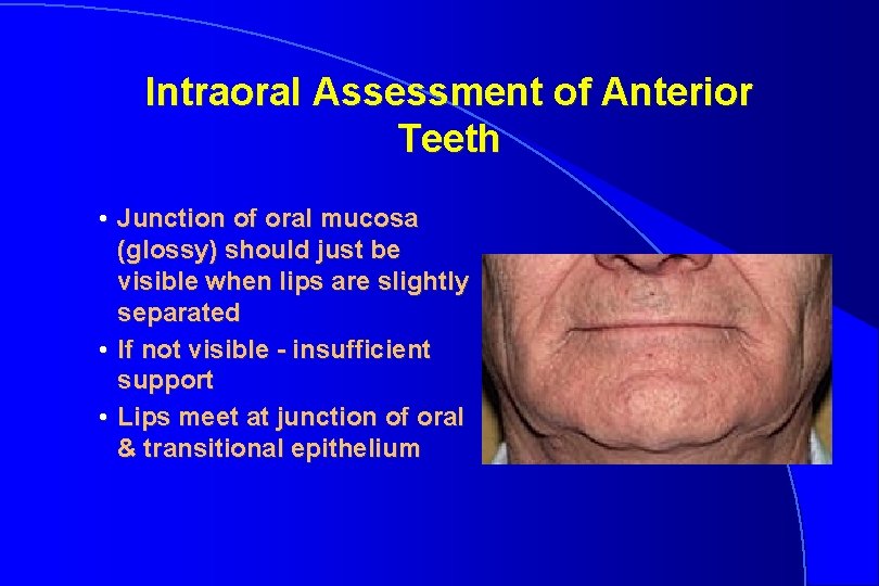 Intraoral Assessment of Anterior Teeth • Junction of oral mucosa (glossy) should just be