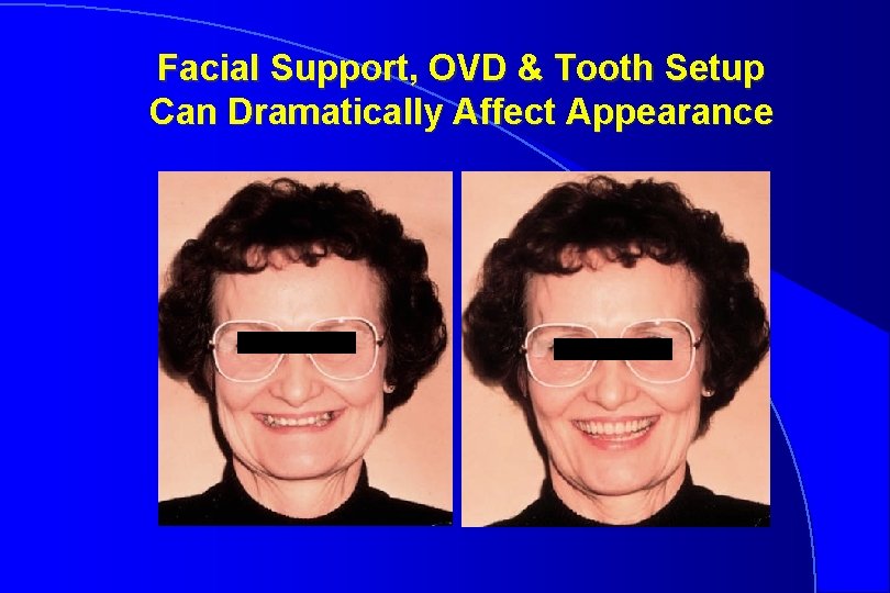 Facial Support, OVD & Tooth Setup Can Dramatically Affect Appearance 