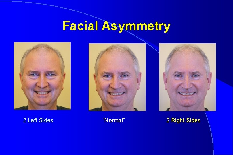 Facial Asymmetry 2 Left Sides “Normal” 2 Right Sides 