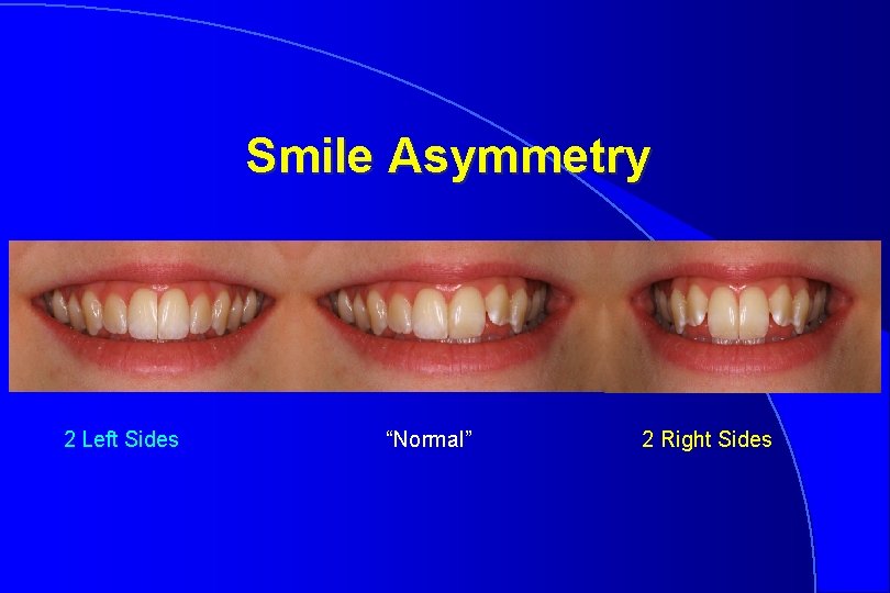 Smile Asymmetry 2 Left Sides “Normal” 2 Right Sides 