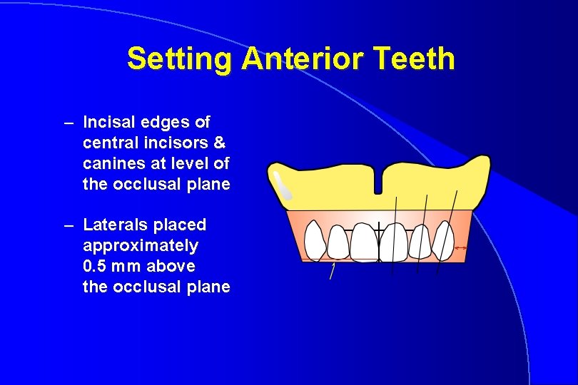 Setting Anterior Teeth – Incisal edges of central incisors & canines at level of