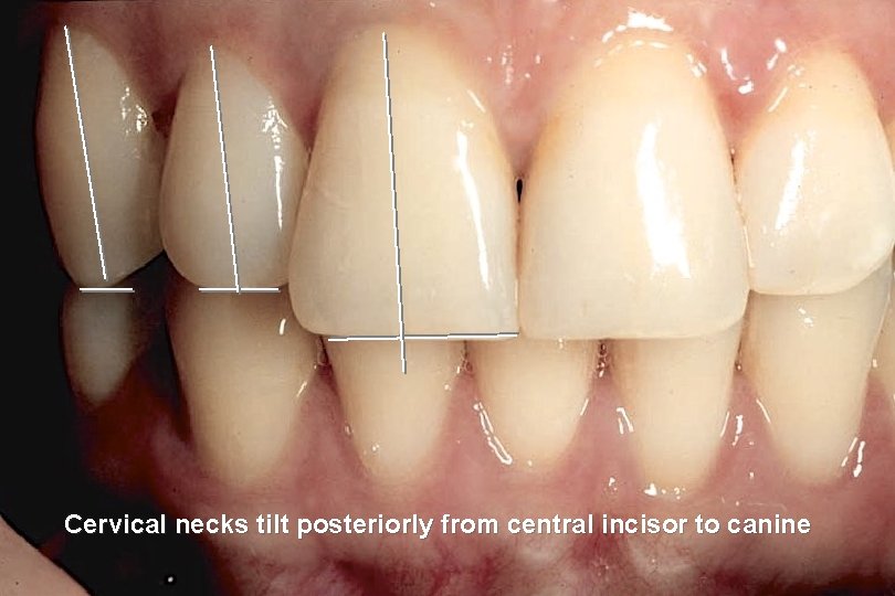 Cervical necks tilt posteriorly from central incisor to canine 