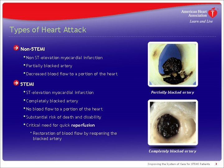 Types of Heart Attack Non-STEMI • Non ST-elevation myocardial infarction • Partially blocked artery Types of Heart Attack Non-STEMI • Non ST-elevation myocardial infarction • Partially blocked artery