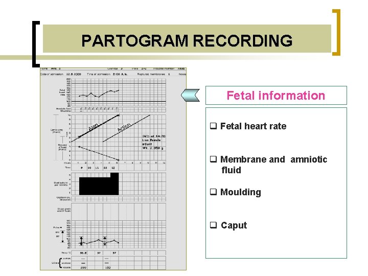 PARTOGRAM RECORDING Fetal information q Fetal heart rate q Membrane and amniotic fluid q