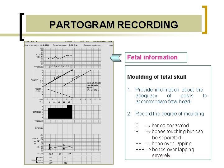 PARTOGRAM RECORDING Fetal information Moulding of fetal skull 1. Provide information about the adequacy