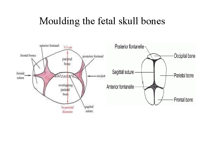 Moulding the fetal skull bones 