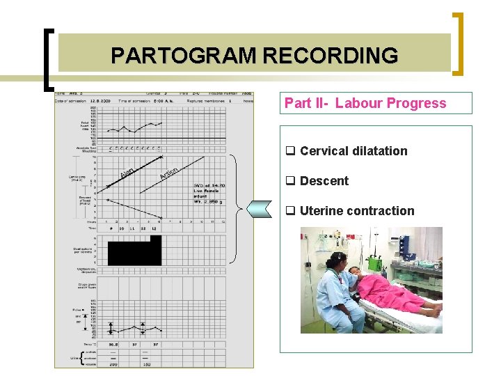 PARTOGRAM RECORDING Part II- Labour Progress q Cervical dilatation q Descent q Uterine contraction