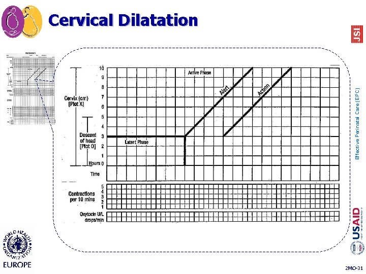 Effective Perinatal Care (EPC) Cervical Dilatation 2 MO-31 