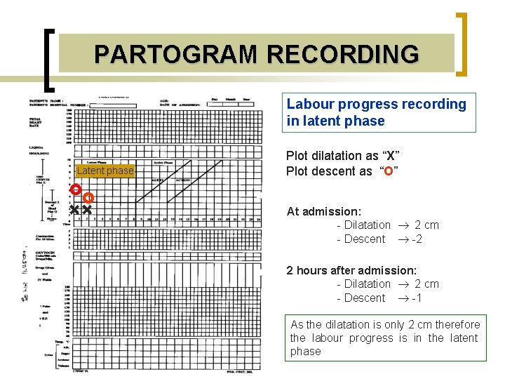 PARTOGRAM RECORDING Labour progress recording in latent phase Latent phase Plot dilatation as “X”