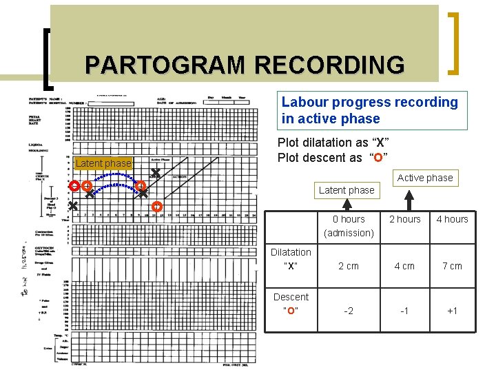 PARTOGRAM RECORDING Labour progress recording in active phase Plot dilatation as “X” Plot descent