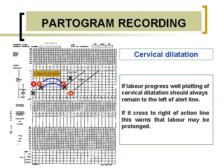 PARTOGRAM RECORDING Cervical dilatation Latent phase + + If labour progress well plotting of