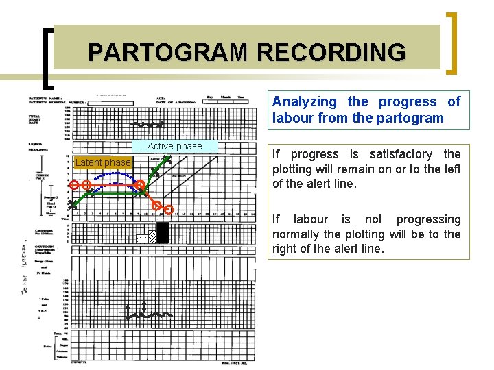 PARTOGRAM RECORDING Analyzing the progress of labour from the partogram Active phase + Latent