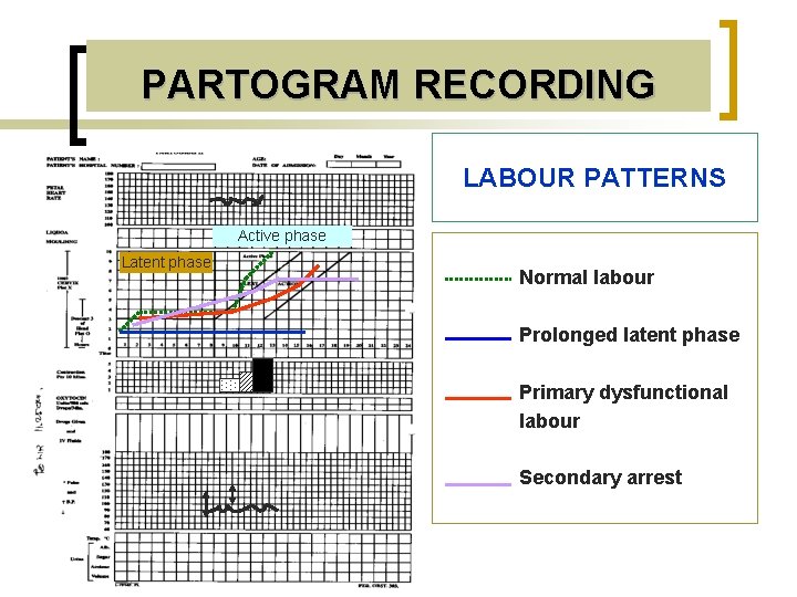 PARTOGRAM RECORDING LABOUR PATTERNS Active phase Latent phase Normal labour Prolonged latent phase Primary