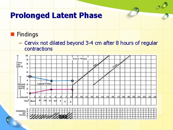 Prolonged Latent Phase n Findings – Cervix not dilated beyond 3 -4 cm after