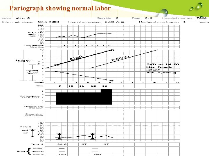 Partograph showing normal labor 