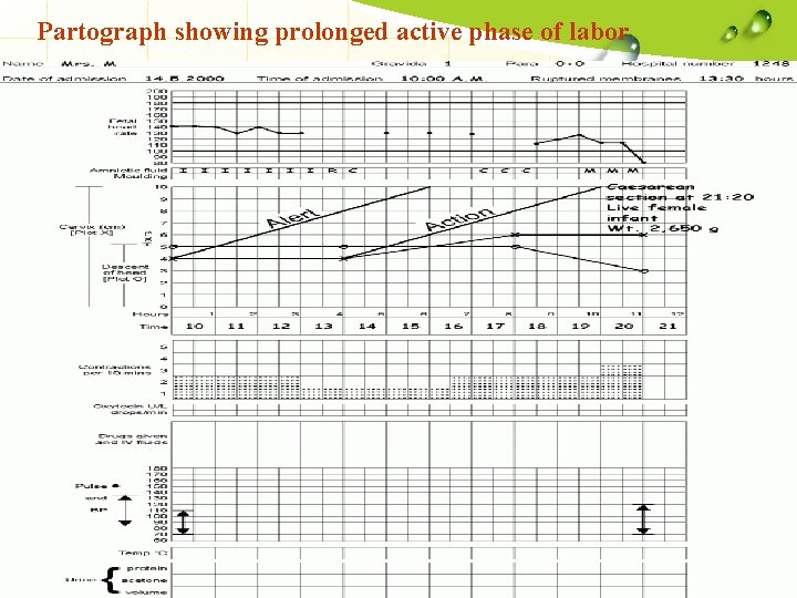 Partograph showing prolonged active phase of labor 