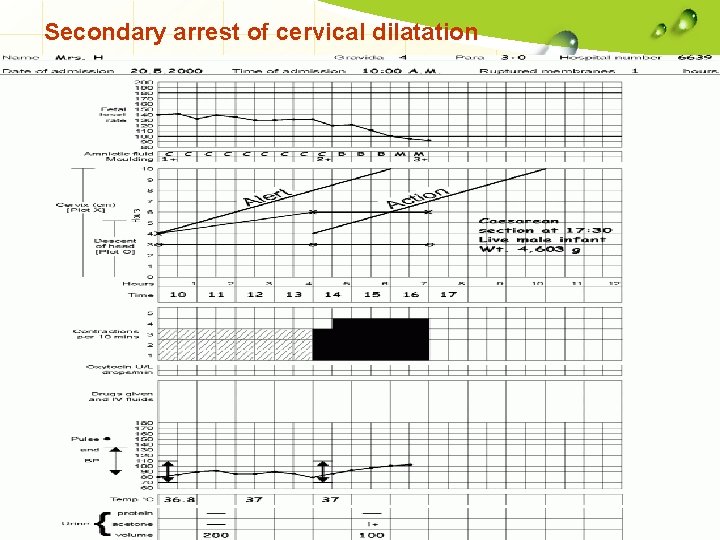 Secondary arrest of cervical dilatation 