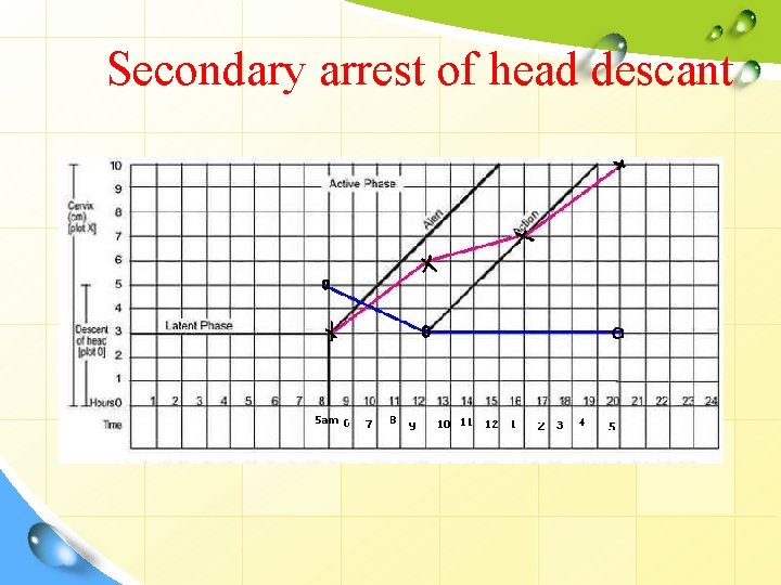 Secondary arrest of head descant 