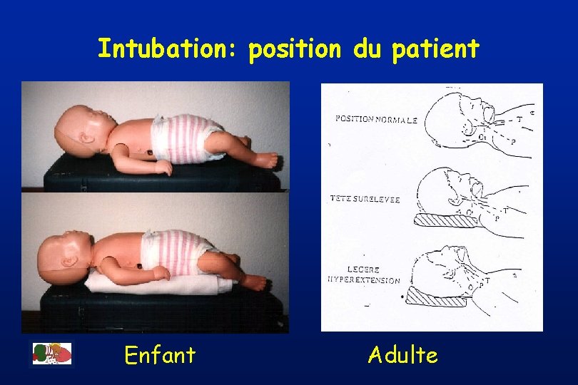Intubation: position du patient Enfant Adulte 