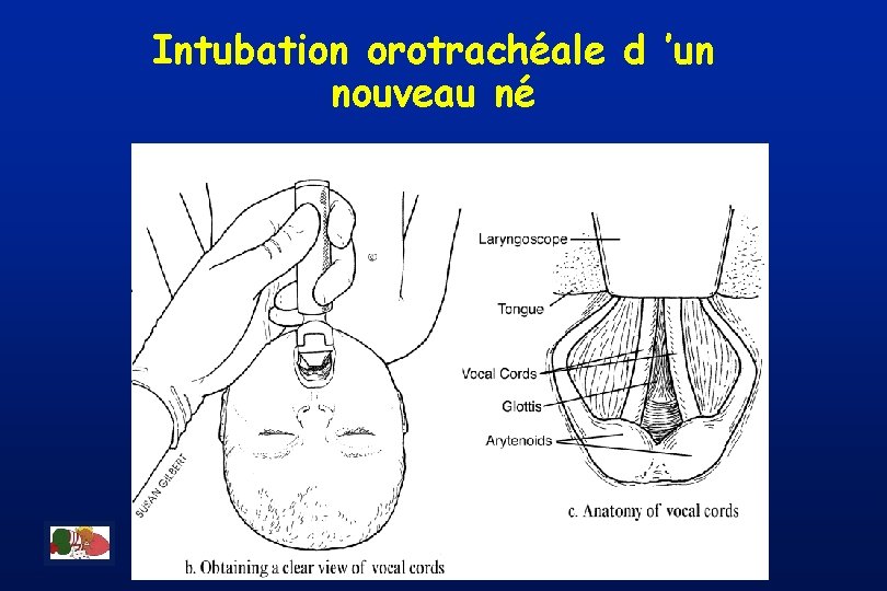 Intubation orotrachéale d ’un nouveau né 