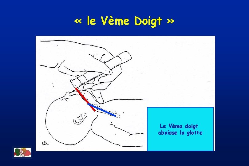  « le Vème Doigt » Le Vème doigt abaisse la glotte 